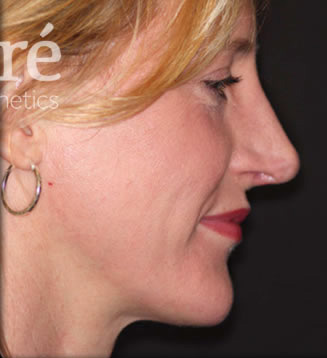Rhinoplasty Patient Photo - Case 5460 - after view-1