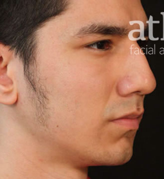 Chin Augmentation Patient Photo - Case 5562 - before view-1