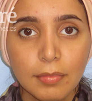 Rhinoplasty Patient Photo - Case 5571 - after view-1