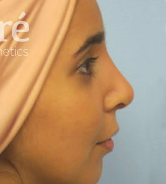 Rhinoplasty Patient Photo - Case 5571 - after view-0