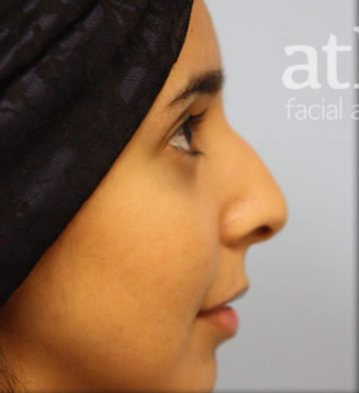 Rhinoplasty Patient Photo - Case 5571 - before view-