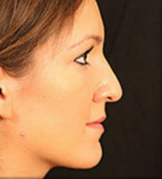 Rhinoplasty Patient Photo - Case 5610 - before view-0