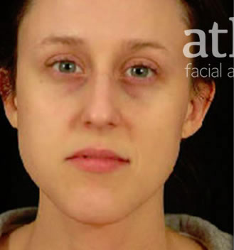 Rhinoplasty Patient Photo - Case 5874 - before view-1
