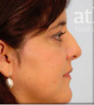 Rhinoplasty Patient Photo - Case 5648 - before view-0