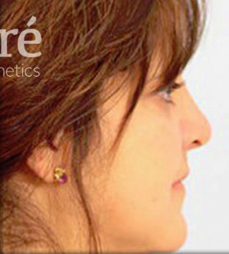Rhinoplasty Patient Photo - Case 5648 - after view-0