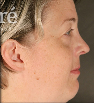 Rhinoplasty Patient Photo - Case 5653 - after view-1