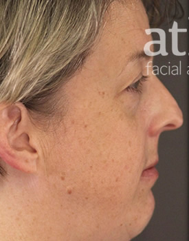Rhinoplasty Patient Photo - Case 5653 - before view-1