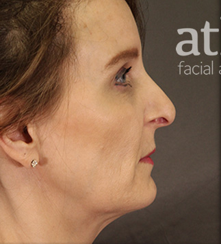Revision Rhinoplasty Patient Photo - Case 5665 - before view-