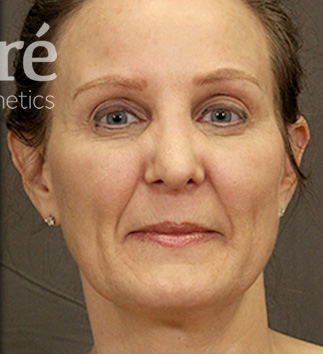 Revision Rhinoplasty Patient Photo - Case 5665 - after view-2
