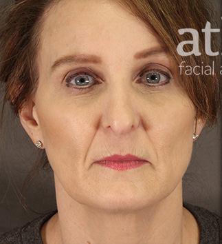 Revision Rhinoplasty Patient Photo - Case 5665 - before view-2