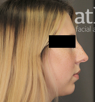 Revision Rhinoplasty Patient Photo - Case 5682 - before view-0