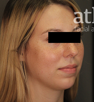 Revision Rhinoplasty Patient Photo - Case 5682 - before view-1