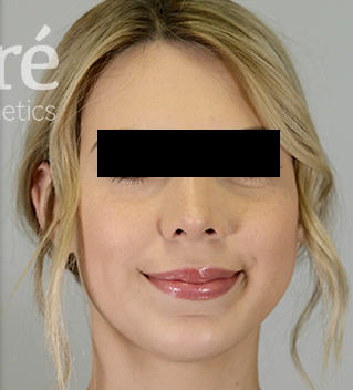 Revision Rhinoplasty Patient Photo - Case 5682 - after view-2