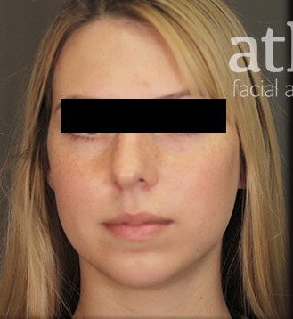 Revision Rhinoplasty Patient Photo - Case 5682 - before view-2
