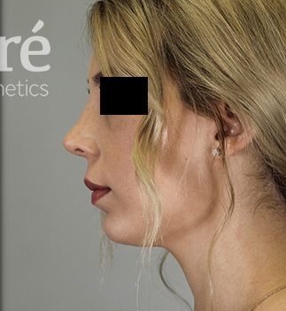 Revision Rhinoplasty Patient Photo - Case 5682 - after view-3