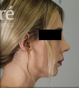 Revision Rhinoplasty Patient Photo - Case 5682 - after view-0