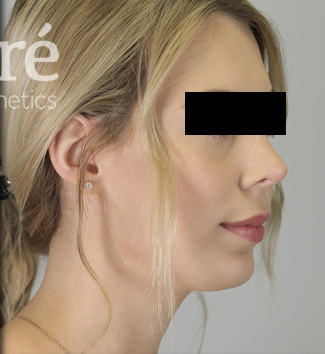 Revision Rhinoplasty Patient Photo - Case 5682 - after view-1