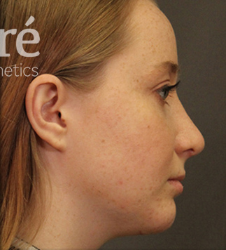 Rhinoplasty Patient Photo - Case 5719 - after view