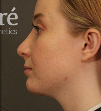 Rhinoplasty Patient Photo - Case 5719 - after view-3