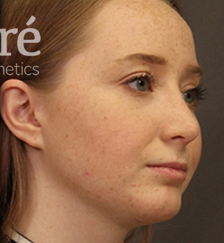 Rhinoplasty Patient Photo - Case 5719 - after view-1