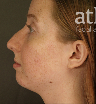 Rhinoplasty Patient Photo - Case 5719 - before view-3