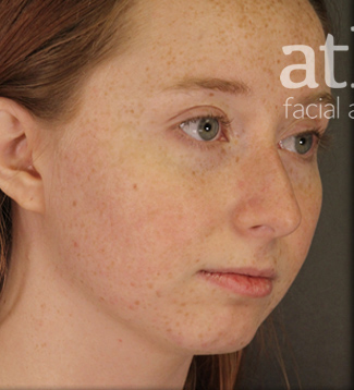 Rhinoplasty Patient Photo - Case 5719 - before view-1