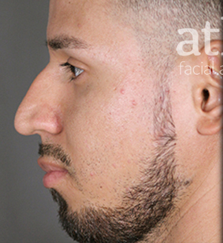 Rhinoplasty Patient Photo - Case 5738 - before view-3