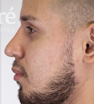 Rhinoplasty Patient Photo - Case 5738 - after view-3