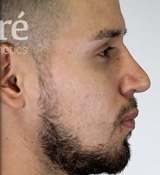 Rhinoplasty Patient Photo - Case 5738 - after view-1
