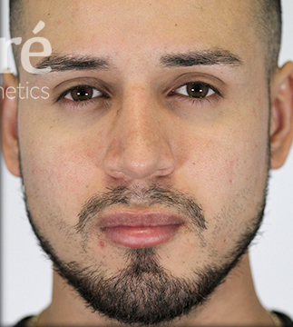 Rhinoplasty Patient Photo - Case 5738 - after view