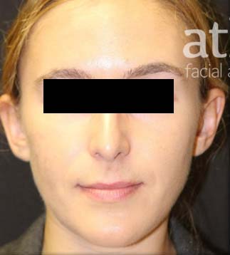 Rhinoplasty Patient Photo - Case 5780 - before view-1