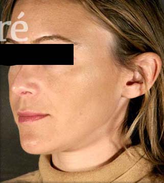Rhinoplasty Patient Photo - Case 5780 - after view-2