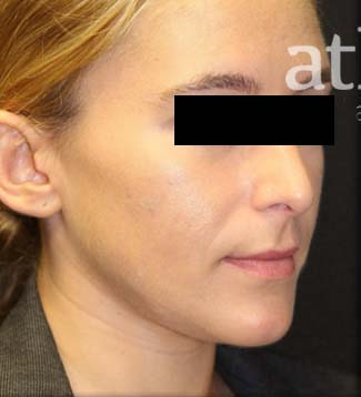 Rhinoplasty Patient Photo - Case 5780 - before view-3