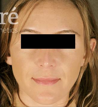 Rhinoplasty Patient Photo - Case 5780 - after view-1