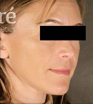 Rhinoplasty Patient Photo - Case 5780 - after view-3