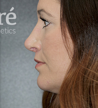 Revision Rhinoplasty Patient Photo - Case 5797 - after view-1