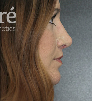 Revision Rhinoplasty Patient Photo - Case 5797 - after view-0