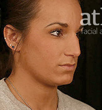Rhinoplasty Patient Photo - Case 5839 - before view-