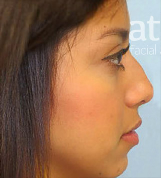 Revision Rhinoplasty Patient Photo - Case 5844 - before view-0