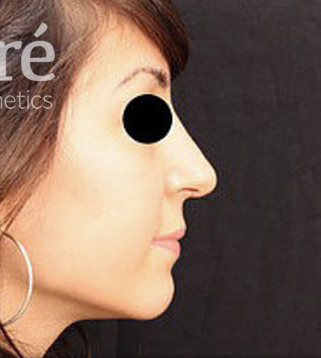 Rhinoplasty Patient Photo - Case 5849 - after view