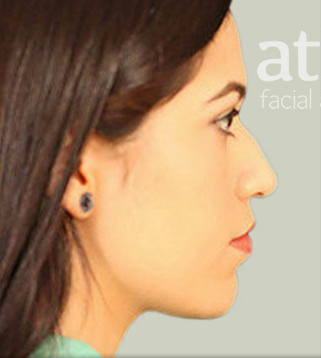 Rhinoplasty Patient Photo - Case 5869 - before view-0
