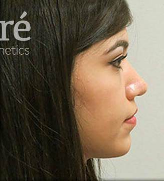 Rhinoplasty Patient Photo - Case 5869 - after view-0