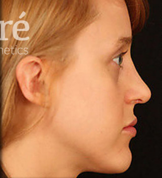 Rhinoplasty Patient Photo - Case 5874 - after view