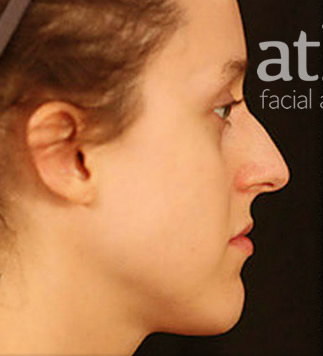 Rhinoplasty Patient Photo - Case 5874 - before view-