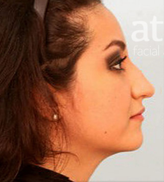 Rhinoplasty Patient Photo - Case 5889 - before view-0