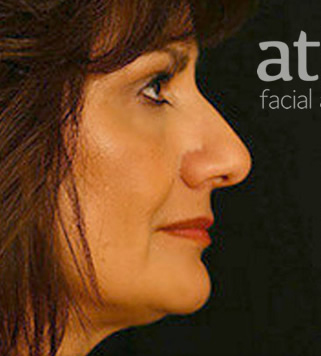 Rhinoplasty Patient Photo - Case 5898 - before view-0