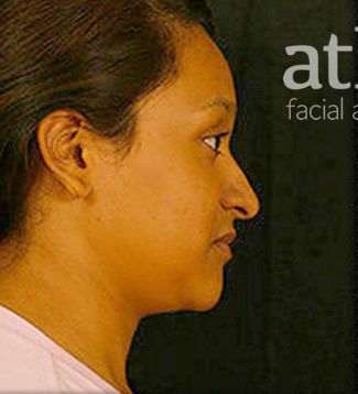Rhinoplasty Patient Photo - Case 5908 - before view-