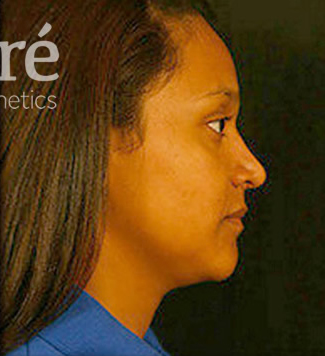 Rhinoplasty Patient Photo - Case 5908 - after view-0