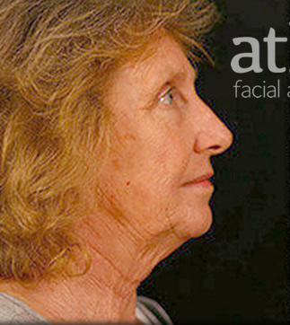 Revision Rhinoplasty Patient Photo - Case 5913 - before view-