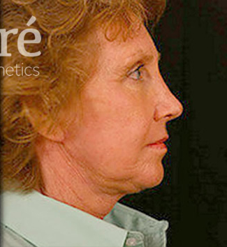 Revision Rhinoplasty Patient Photo - Case 5913 - after view-0